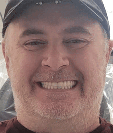 Before treatment — A Refreshed Smile