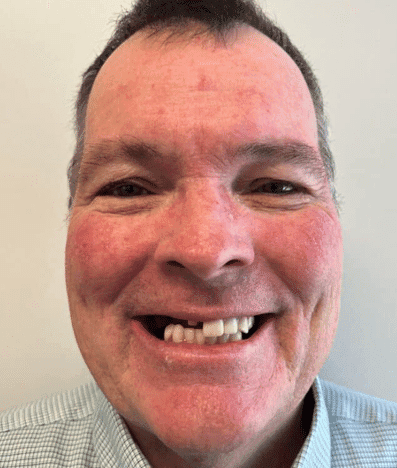 Before treatment — Restoring a Confident Smile