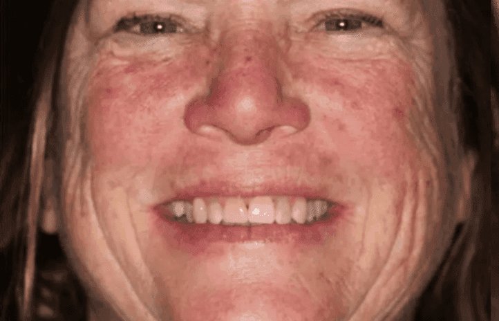 After treatment — Restoring Missing Front Teeth