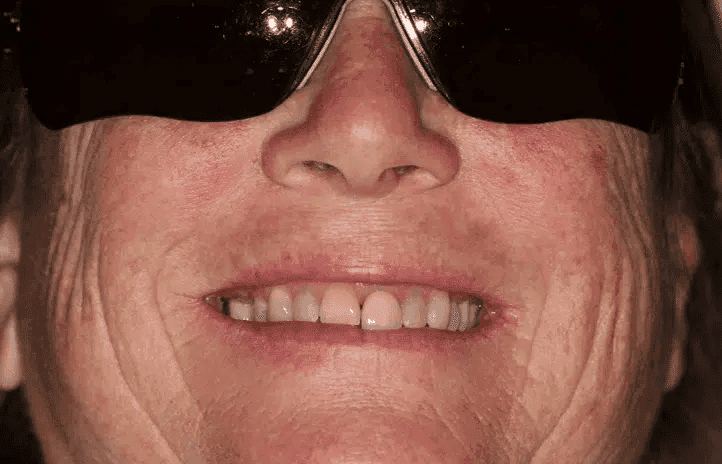Before treatment — Restoring Missing Front Teeth