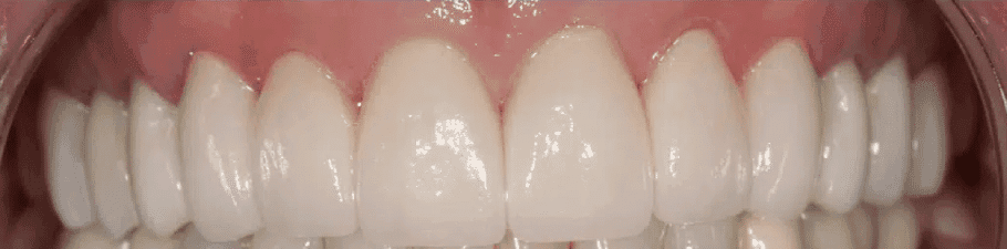 After treatment — Full Upper Rehabilitation