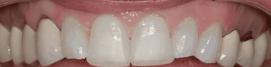 Before treatment — Full Upper Rehabilitation