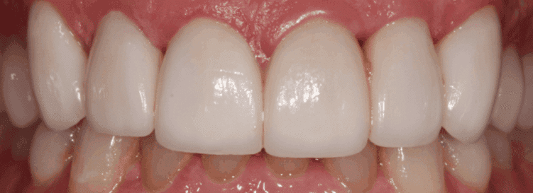 After treatment — A More Even Smile