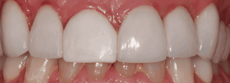 Before treatment — A More Even Smile