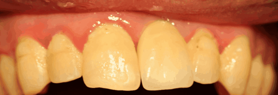After treatment — Trauma Restored With an Implant