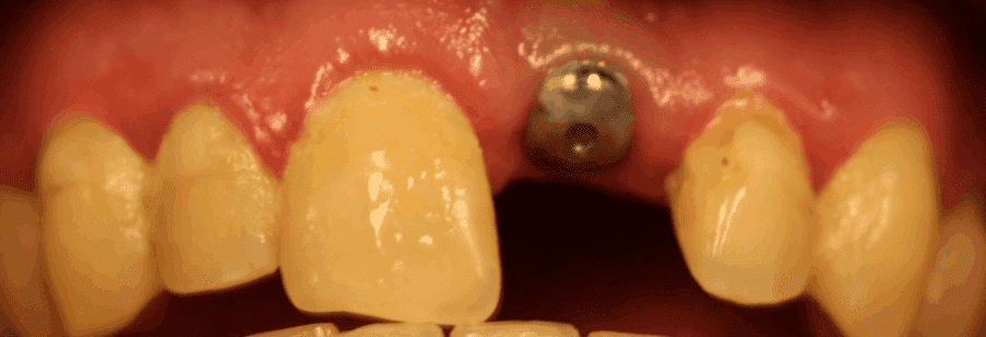 Before treatment — Trauma Restored With an Implant