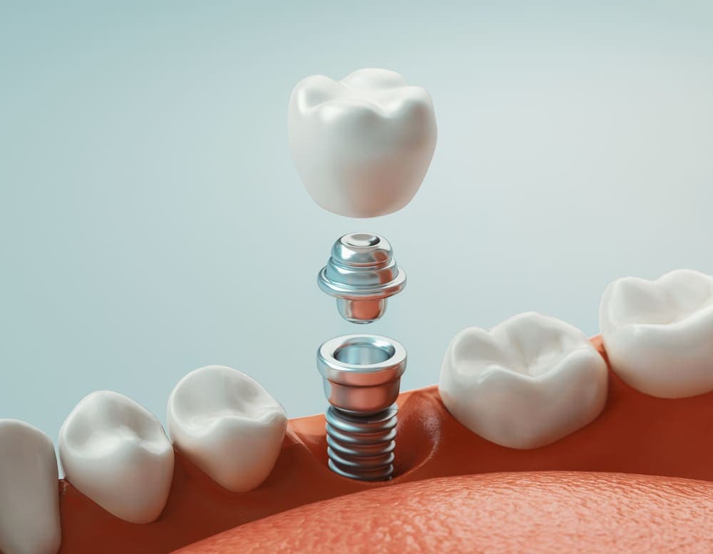 Dental Implants: Your Guide to a Restored Smile
