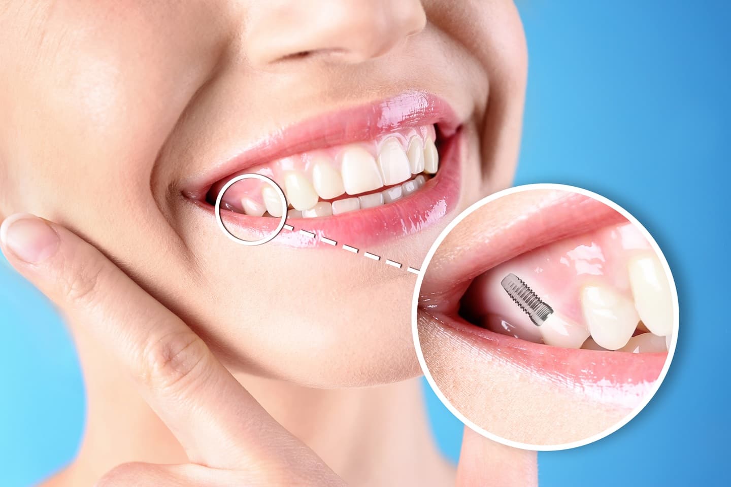 Implant-Supported Bridges: A Better Solution