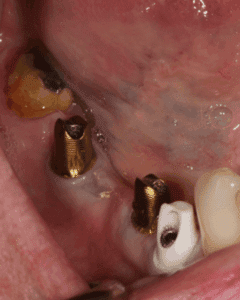Before treatment — Implants and Crowns After a Failed Bridge