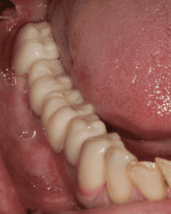 After treatment — Implants and Crowns After a Failed Bridge
