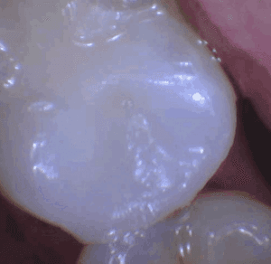 After treatment — Fractured Tooth Repair