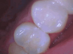 After treatment — Tooth-Colored Filling