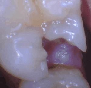 Before treatment — Fractured Tooth Repair