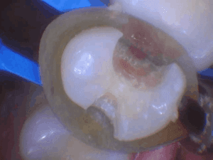 Before treatment — Tooth-Colored Filling