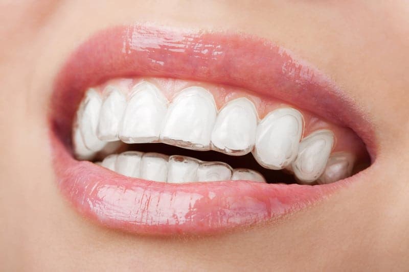 Mastering Invisalign: Tips for a Successful Treatment