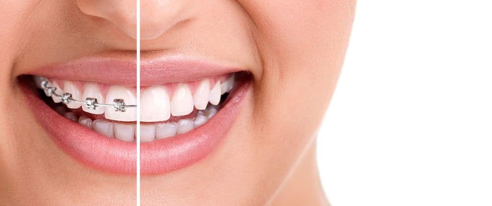 Comparison of traditional metal braces and Invisalign