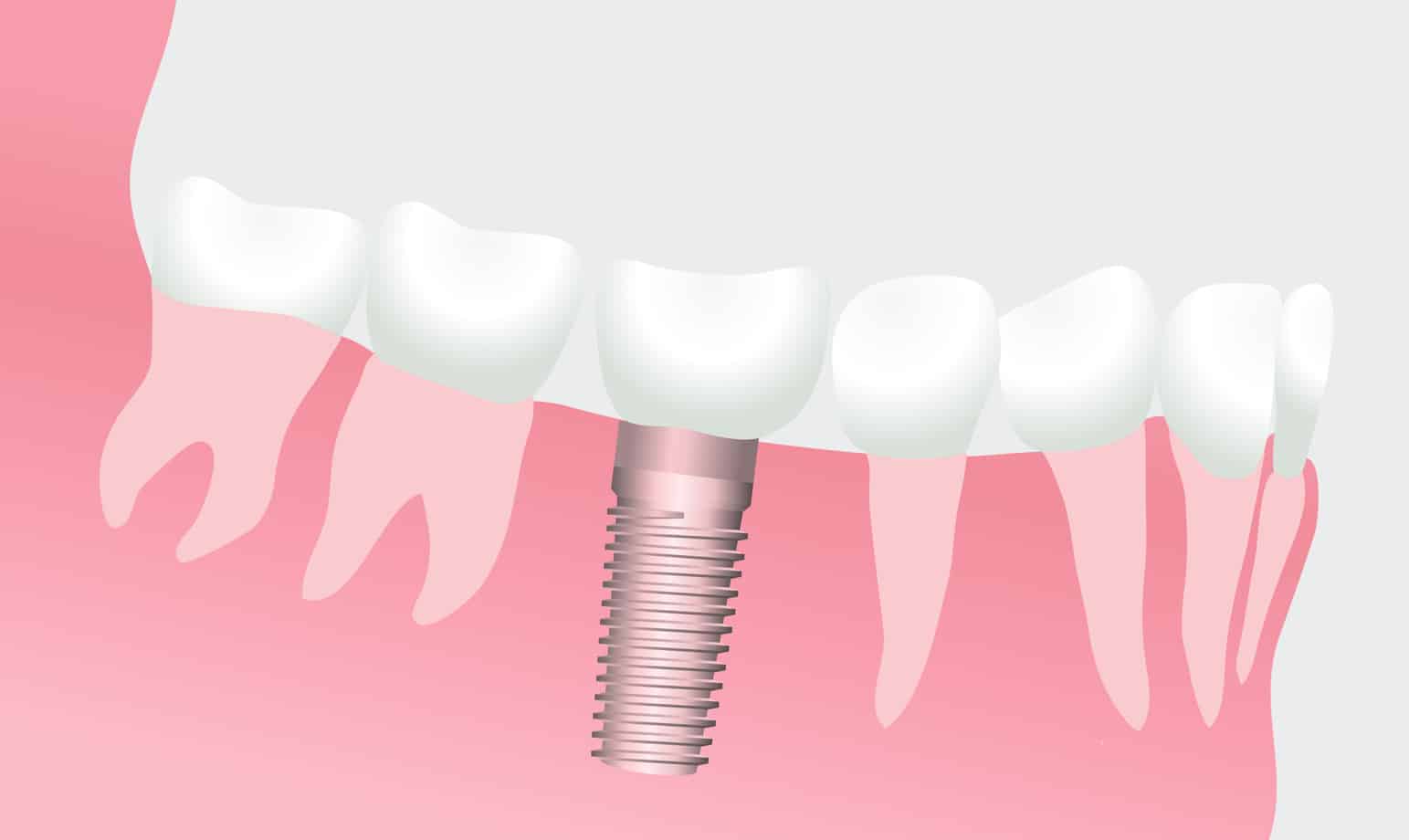 Illustration of a dental implant in a patient's gumline to replace a missing tooth