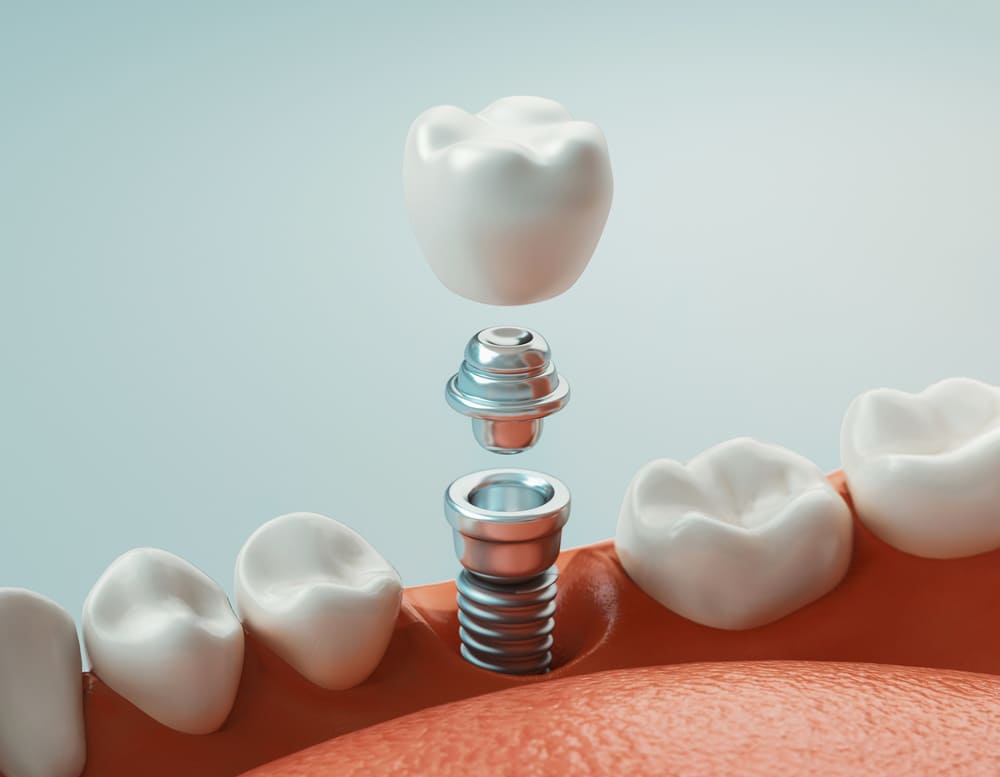 Dental Implants: Your Guide to a Restored Smile