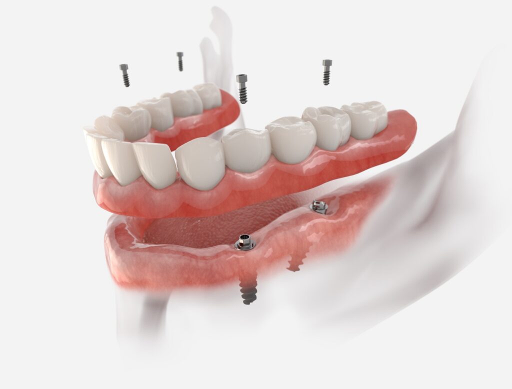 All-on-4 Dental Implants: A Complete Guide